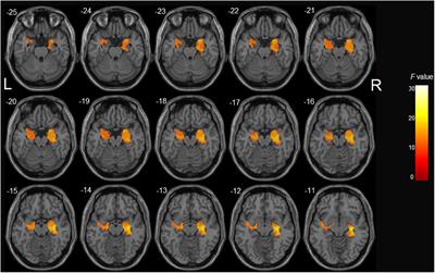 The Influence of MTHFR Polymorphism on Gray Matter Volume in Patients With Amnestic Mild Cognitive Impairment